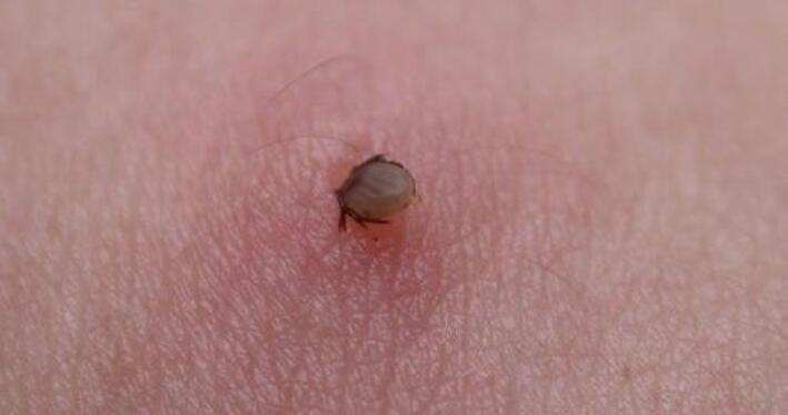 蜱虫叮咬后症状图片 蜱虫咬了什么症状