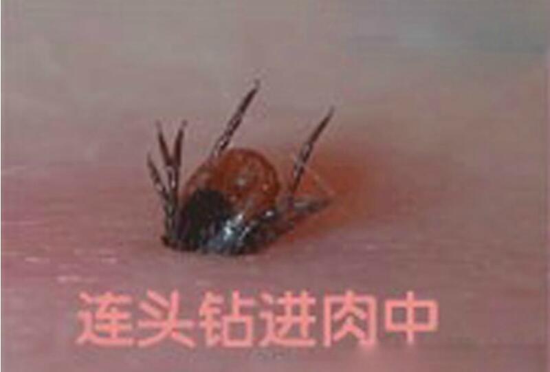 蜱虫叮咬后症状图片 蜱虫咬了什么症状