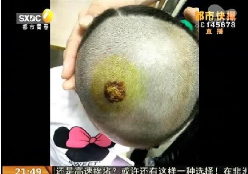 蜱虫叮咬后症状图片 蜱虫咬了什么症状