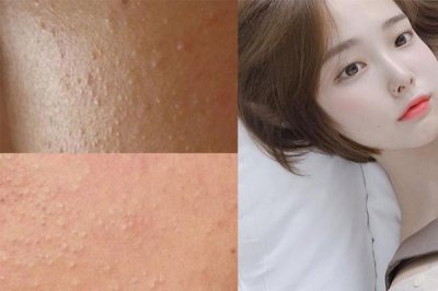 ​怎么区分脂肪粒和闭口 脂肪粒和闭口的区别