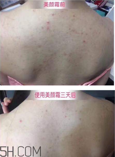 伊妮娜美颜霜有激素吗 伊妮娜美颜霜有依赖吗