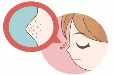 ​黑头是怎么产生的 黑头可以挤吗