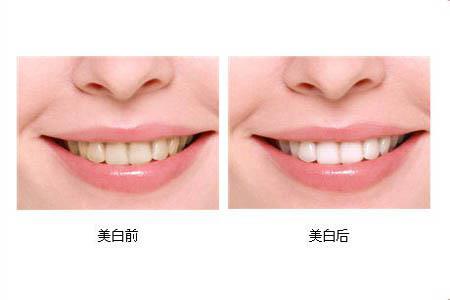 冷光美白牙齿可以保持多长时间？冷光美白牙齿有副作用吗？