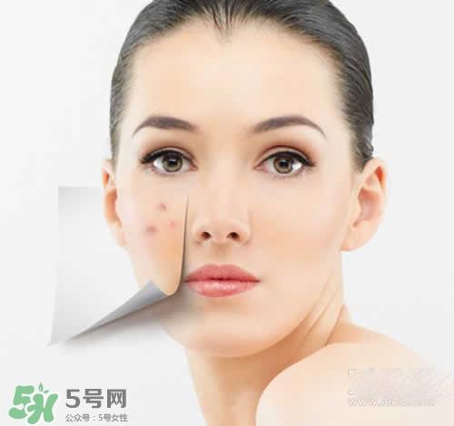 黑色痘印多久会消失？黑色痘印消失时间