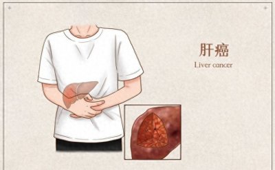 ​你的指甲上有竖纹吗？小心这可能是身体发出的警报！