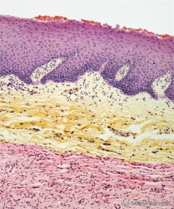 ​神经纤维瘤常见的两大型