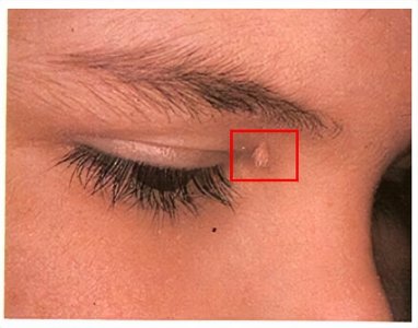 ​眼皮上长了丝状疣，是因为私生活太混乱？