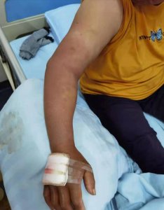 ​广东女子遭剧毒烙铁头袭击，号称蛇中“烂肉王”，到底有多恐怖？