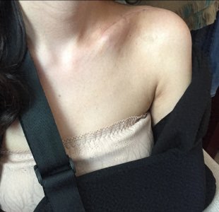 ​王乐君自曝被胡歌砸断锁骨，手术打七根钢钉，剧组封口不让外传！